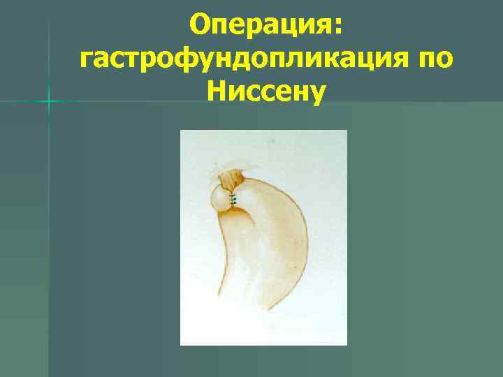 Операция: гастрофундопликация по Ниссену 
