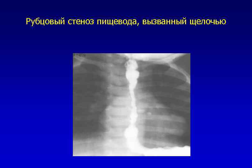 Рубцовый стеноз пищевода, вызванный щелочью 