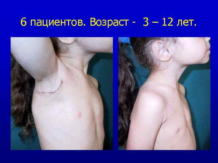 6 пациентов. Возраст - 3 – 12 лет. 