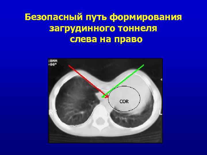 Безопасный путь формирования загрудинного тоннеля слева на право 