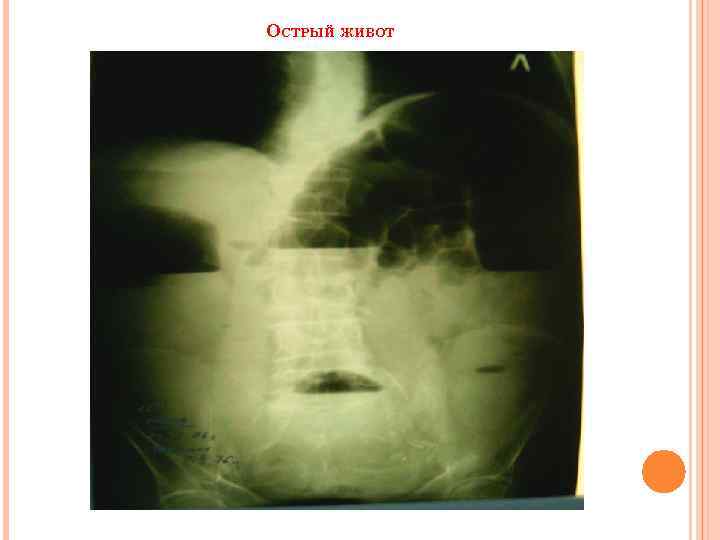 ОСТРЫЙ ЖИВОТ 