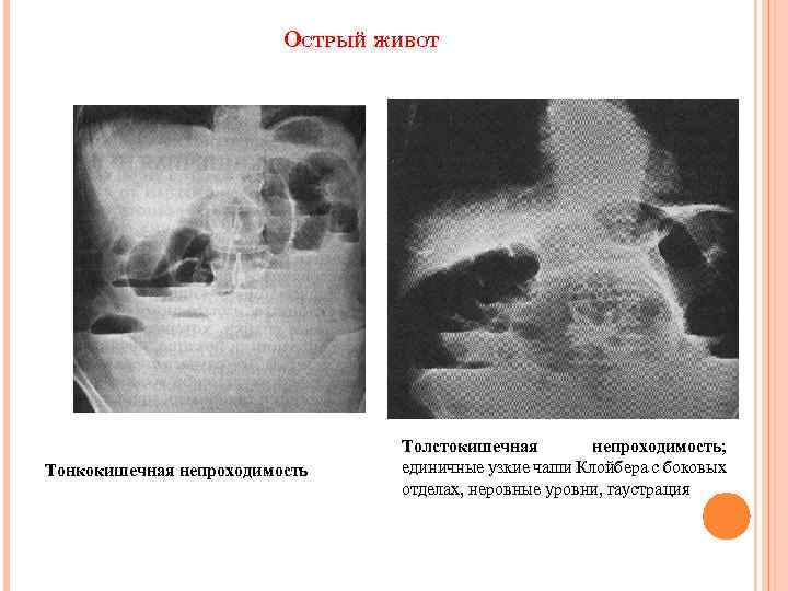 ОСТРЫЙ ЖИВОТ Тонкокишечная непроходимость Толстокишечная непроходимость; единичные узкие чаши Клойбера с боковых отделах, неровные