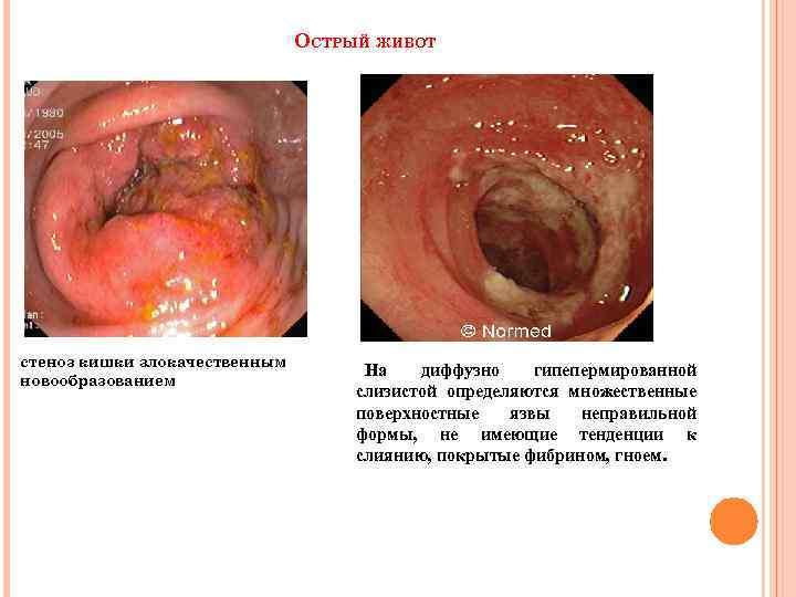 ОСТРЫЙ ЖИВОТ стеноз кишки злокачественным новообразованием На диффузно гипепермированной слизистой определяются множественные поверхностные язвы