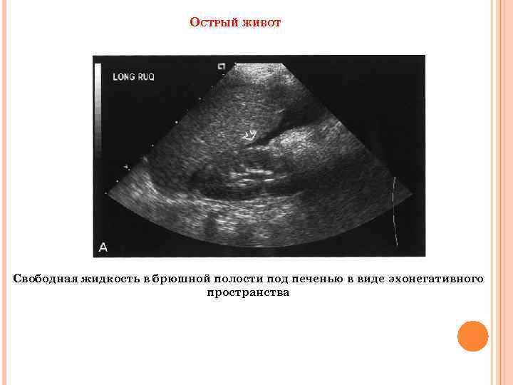 ОСТРЫЙ ЖИВОТ Свободная жидкость в брюшной полости под печенью в виде эхонегативного пространства 