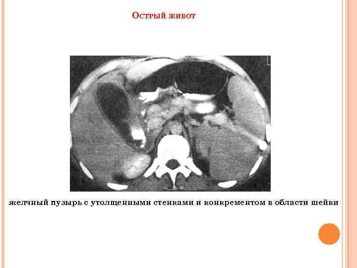 ОСТРЫЙ ЖИВОТ желчный пузырь с утолщенными стенками и конкрементом в области шейки 