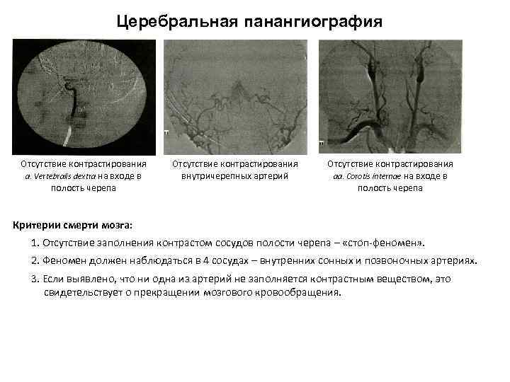 Церебральная панангиография Отсутствие контрастирования а. Vertebralis dextra на входе в полость черепа Отсутствие контрастирования
