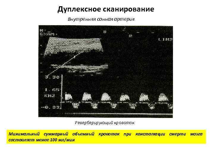 Дуплексное сканирование Внутренняя сонная артерия Реверберирующий кровоток Минимальный суммарный объемный кровоток при констатации смерти