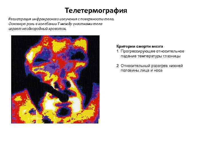 Телетермография Регистрация инфракрасного излучения с поверхности тела. Основную роль в колебании Т между участками