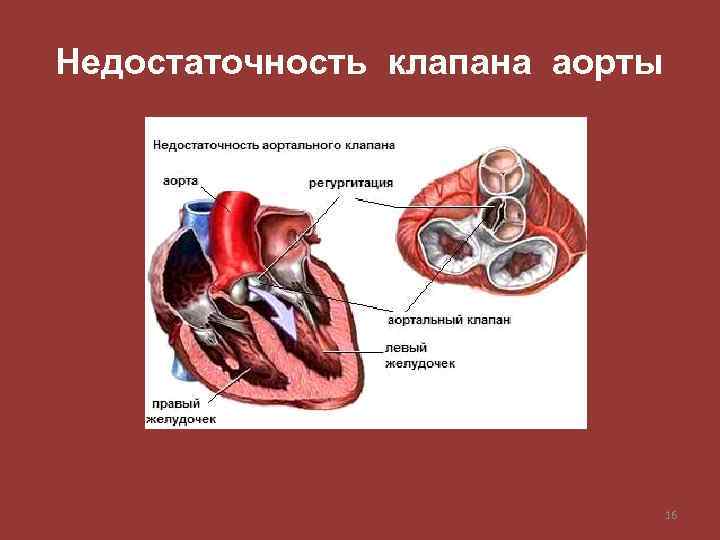 Недостаточность клапана аорты 16 