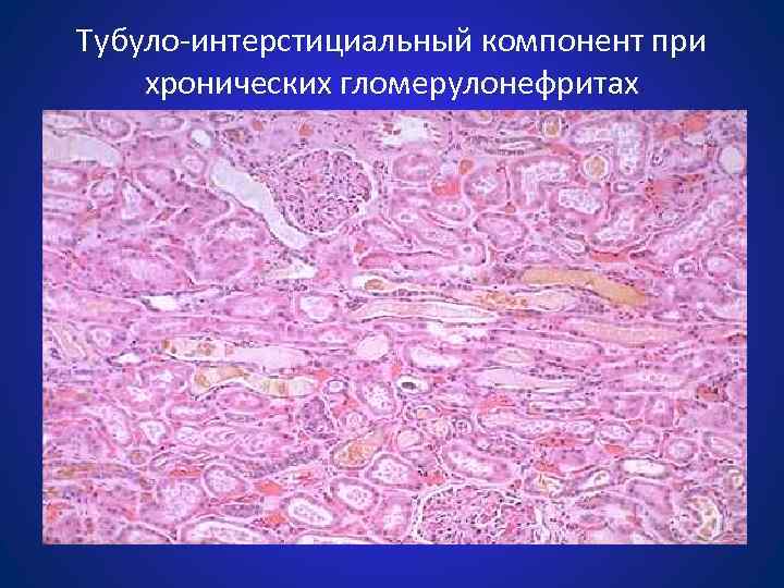 Интерстициальный нефрит симптомы у женщин. Тубулоинтерстициальный нефрит патанатомия. Хронический тубулоинтерстициальный нефрит микропрепарат. Интерстициальный нефрит гистопрепарат. Интерстициальный нефрит гистология.