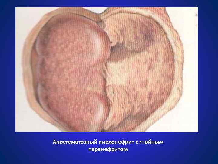 Апостематозный пиелонефрит с гнойным паранефритом 
