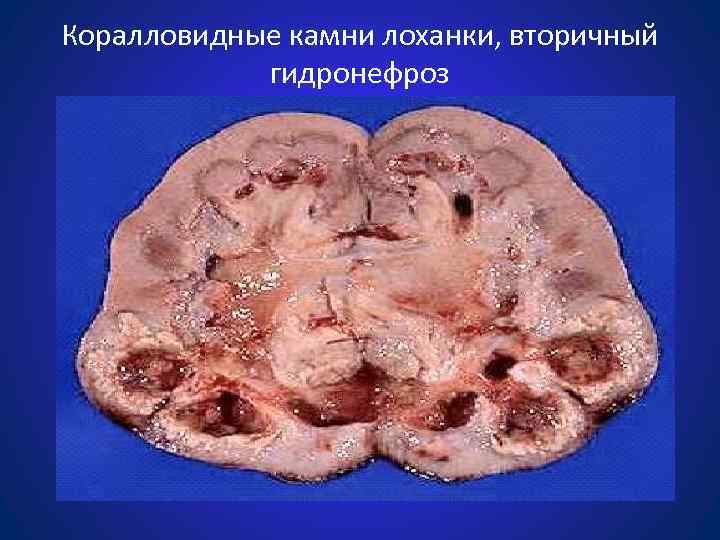 Коралловидные камни лоханки, вторичный гидронефроз 