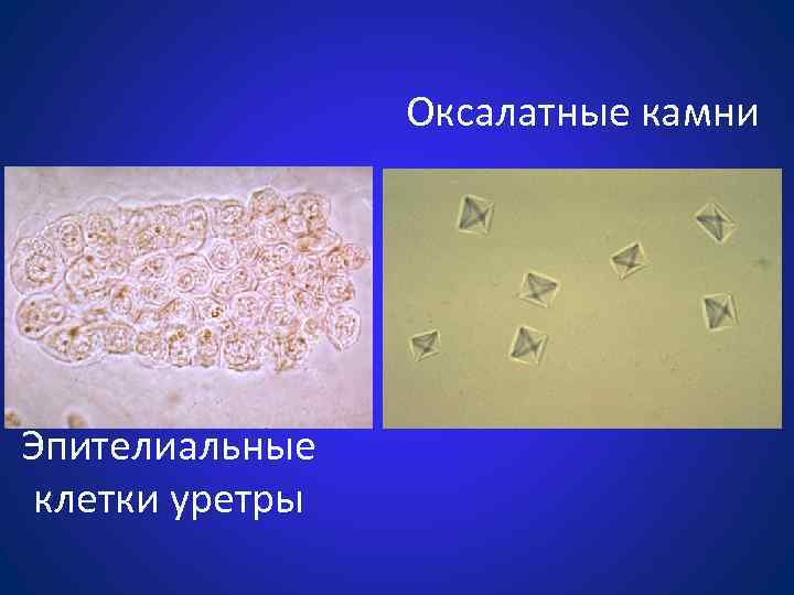 Оксалатные камни Эпителиальные клетки уретры 