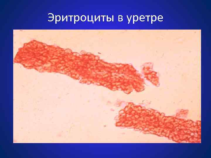 Эритроциты в уретре 