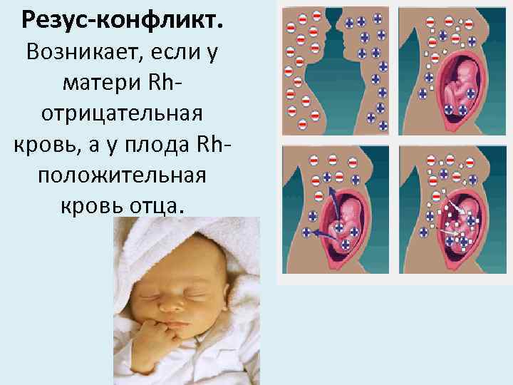 Резус-конфликт. Возникает, если у матери Rhотрицательная кровь, а у плода Rhположительная кровь отца. 