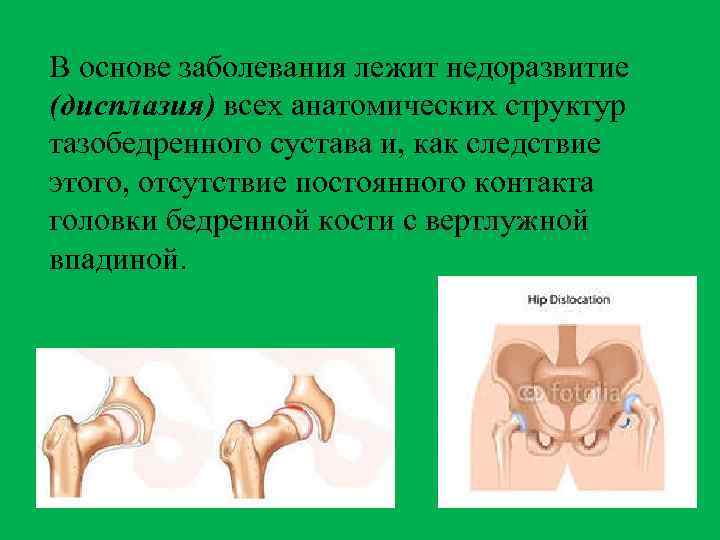 В основе заболевания лежит недоразвитие (дисплазия) всех анатомических структур тазобедренного сустава и, как следствие