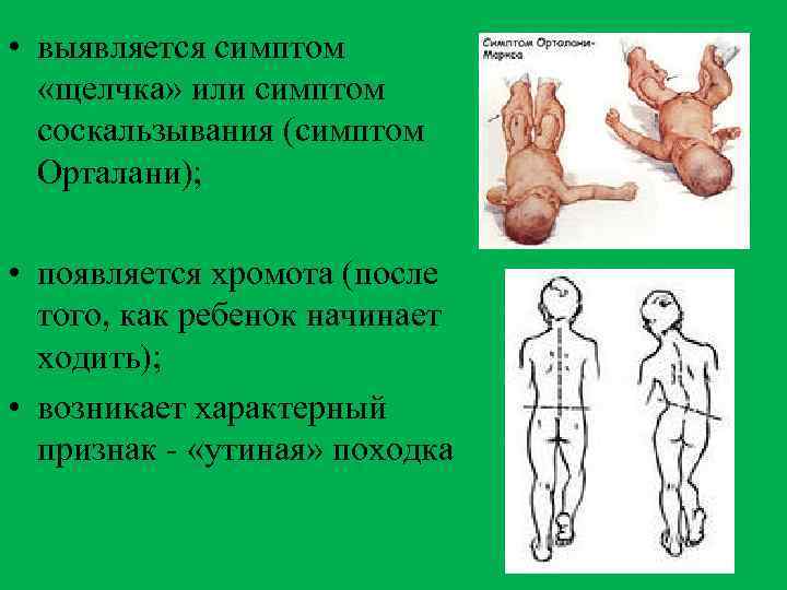  • выявляется симптом «щелчка» или симптом соскальзывания (симптом Орталани); • появляется хромота (после