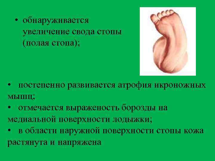  • обнаруживается увеличение свода стопы (полая стопа); • постепенно развивается атрофия икроножных мышц;