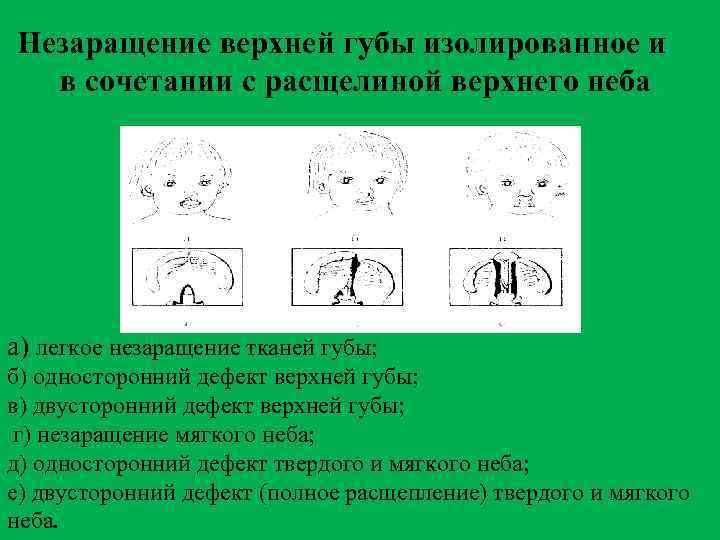 Незаращение верхней губы изолированное и в сочетании с расщелиной верхнего неба а) легкое незаращение