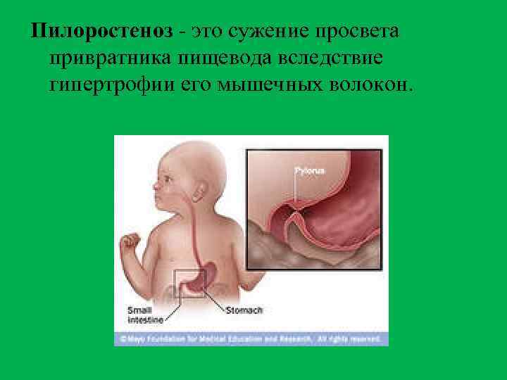 Пилоростеноз - это сужение просвета привратника пищевода вследствие гипертрофии его мышечных волокон. 