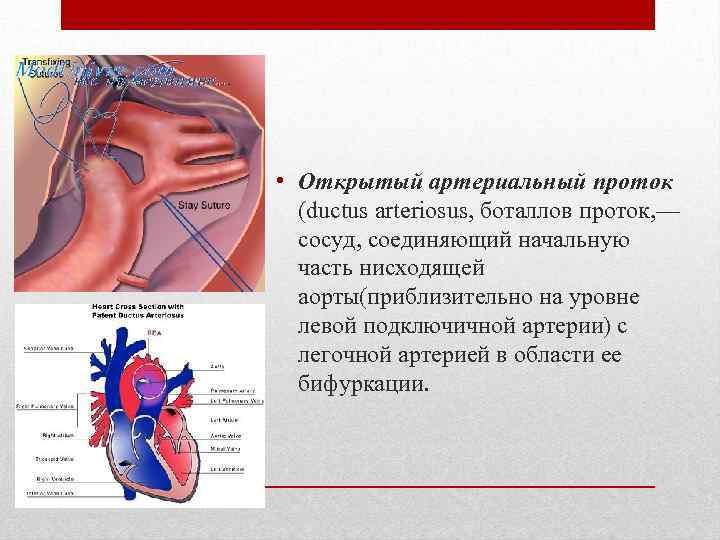 Аускультативная картина при открытом артериальном протоке характеризуется наличием