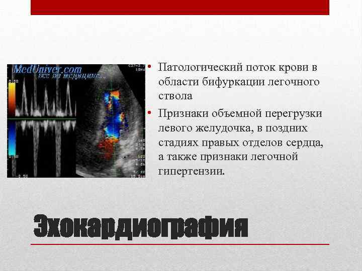  • Патологический поток крови в области бифуркации легочного ствола • Признаки объемной перегрузки