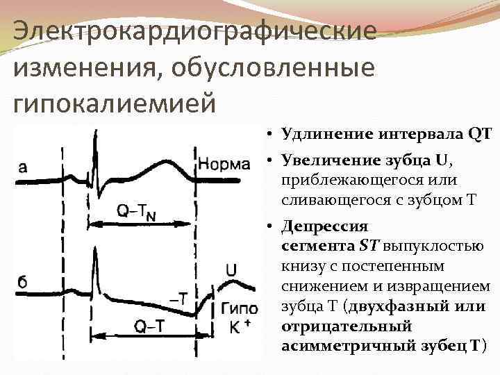 Гипокалиемия на экг картинки