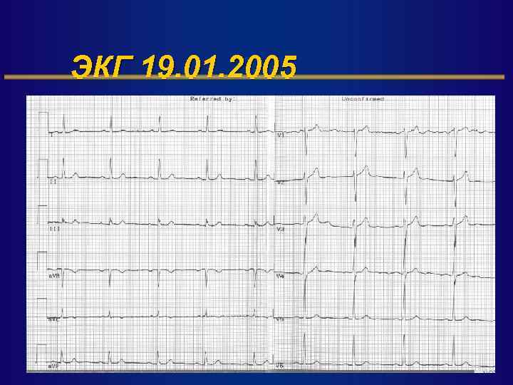 ЭКГ 19. 01. 2005 