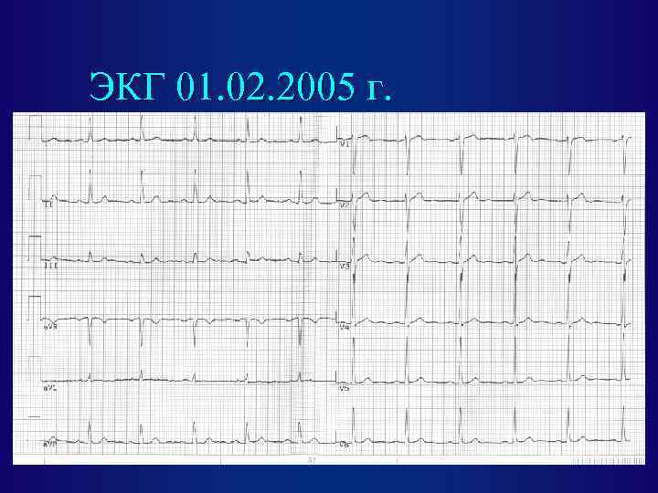 ЭКГ 01. 02. 2005 г. 
