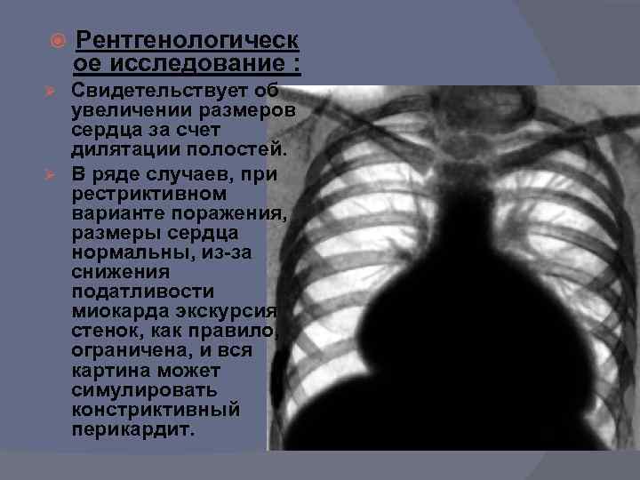  Рентгенологическ ое исследование : Свидетельствует об увеличении размеров сердца за счет дилятации полостей.
