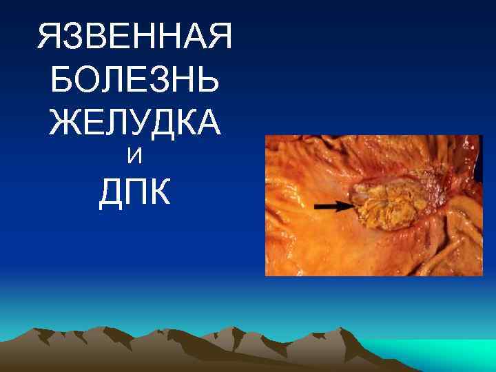 ЯЗВЕННАЯ БОЛЕЗНЬ ЖЕЛУДКА И ДПК 