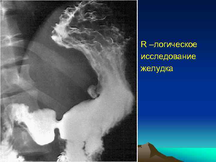 R –логическое исследование желудка 