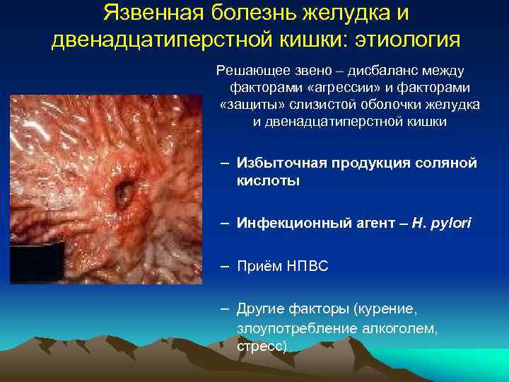 Язвенная болезнь желудка и двенадцатиперстной кишки: этиология Решающее звено – дисбаланс между факторами «агрессии»