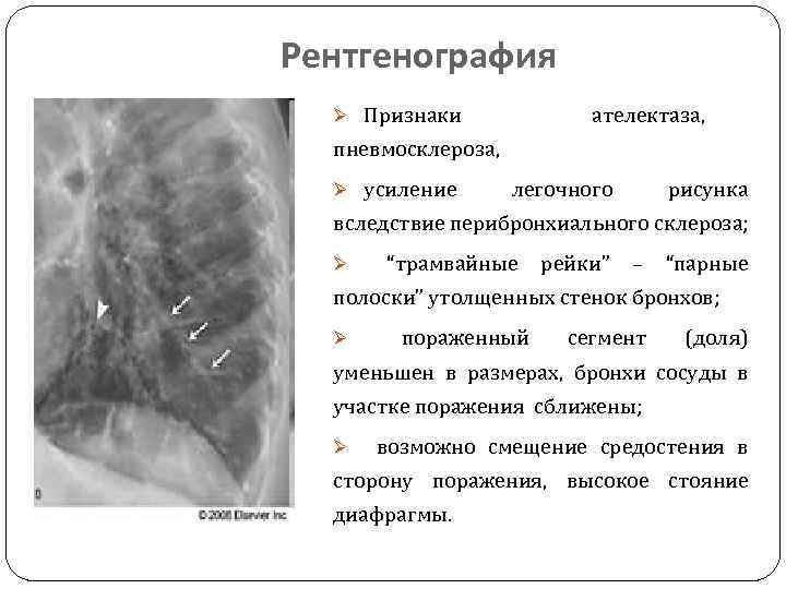 Рентгенография Ø Признаки ателектаза, пневмосклероза, Ø усиление легочного рисунка вследствие перибронхиального склероза; Ø “трамвайные