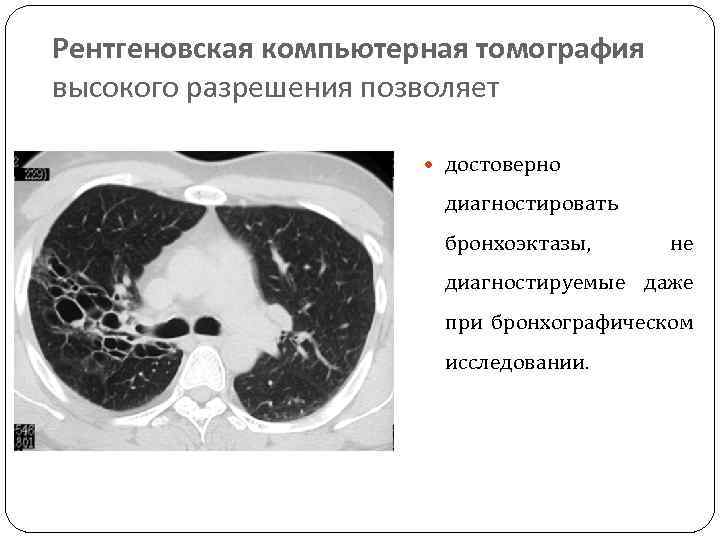 Рентгеновская компьютерная томография высокого разрешения позволяет достоверно диагностировать бронхоэктазы, не диагностируемые даже при бронхографическом