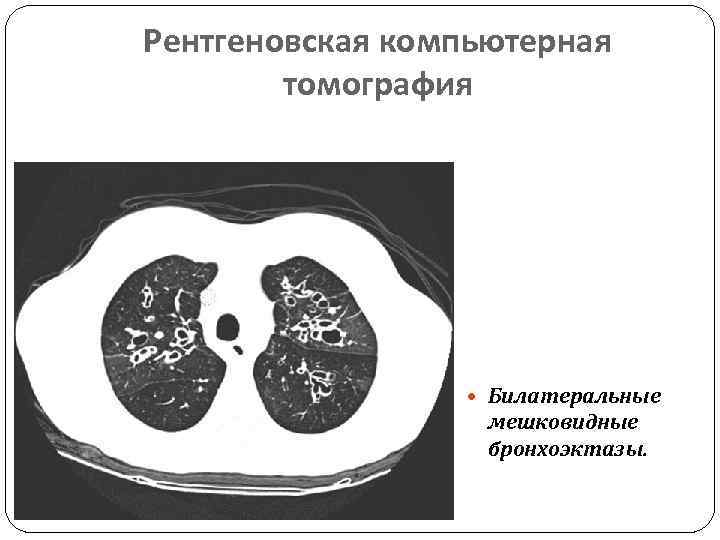 Рентгеновская компьютерная томография Билатеральные мешковидные бронхоэктазы. 