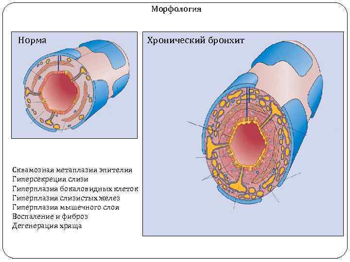 Морфология Норма Сквамозная метаплазия эпителия Гиперсекреция слизи Гиперплазия бокаловидных клеток Гиперплазия слизистых желез Гиперплазия
