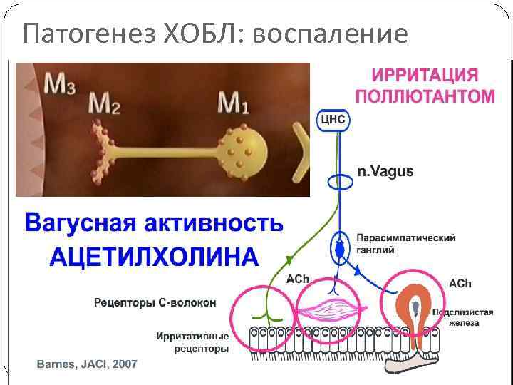 Патогенез ХОБЛ: воспаление 