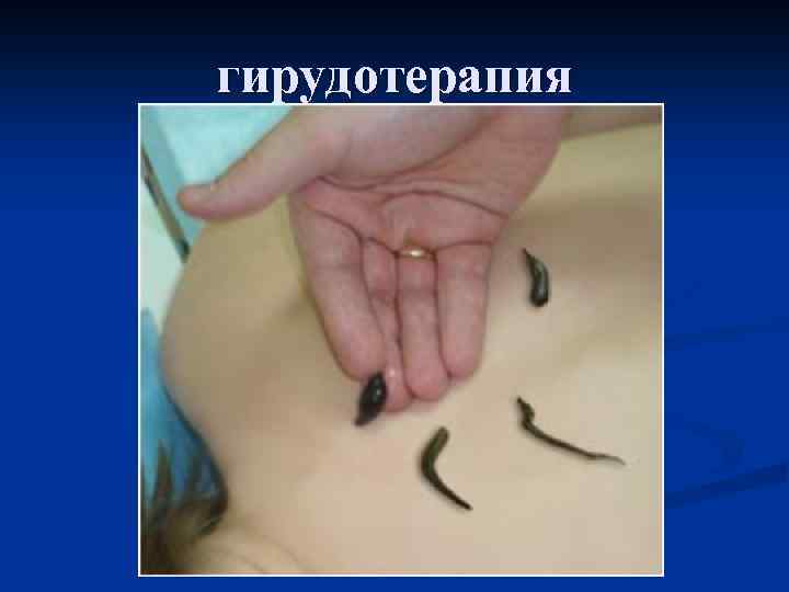 гирудотерапия 