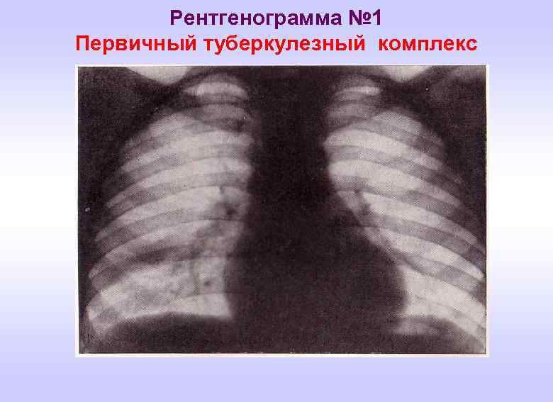 Рентгенограмма № 1 Первичный туберкулезный комплекс 