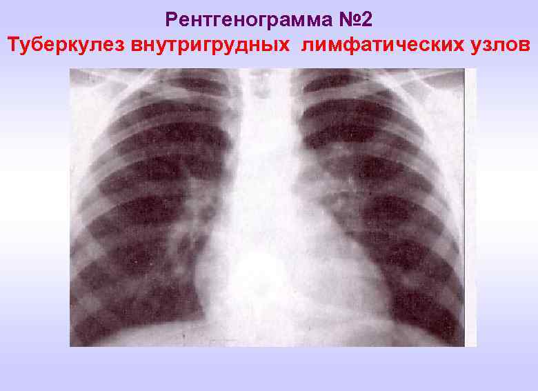 Рентгенограмма № 2 Туберкулез внутригрудных лимфатических узлов 