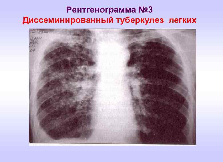 Рентгенограмма № 3 Диссеминированный туберкулез легких 