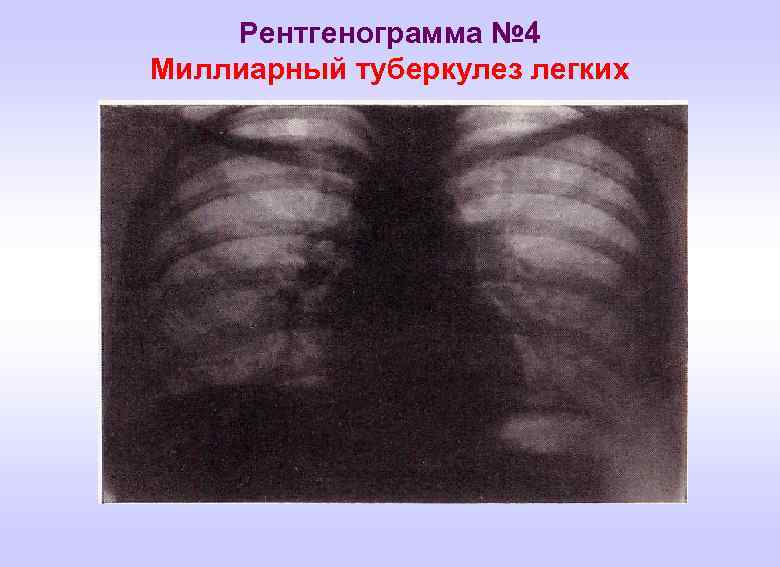 Рентгенограмма № 4 Миллиарный туберкулез легких 