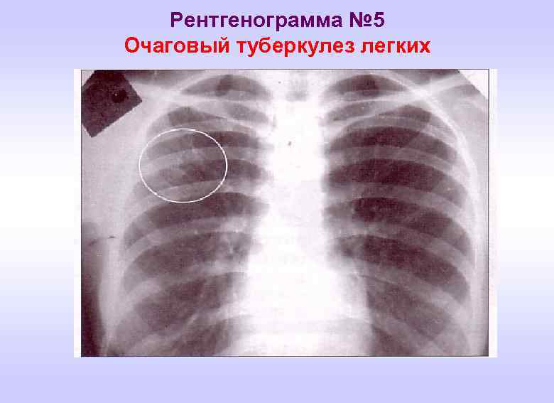 Рентгенограмма № 5 Очаговый туберкулез легких 