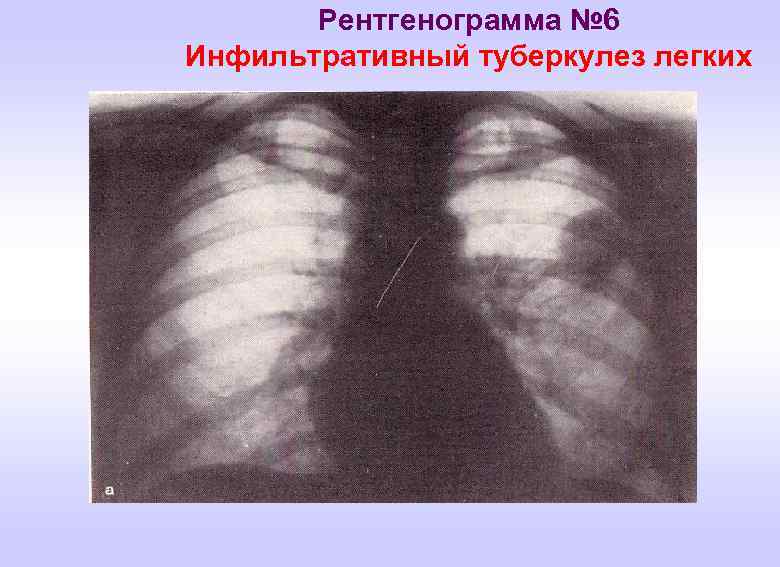 Рентгенограмма № 6 Инфильтративный туберкулез легких 