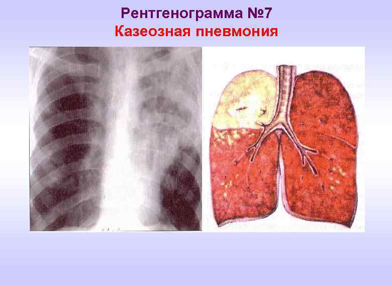Казеозная пневмония фото