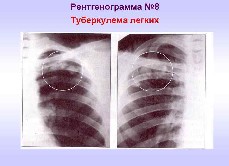 Туберкулинодиагностика фтизиатрия презентация