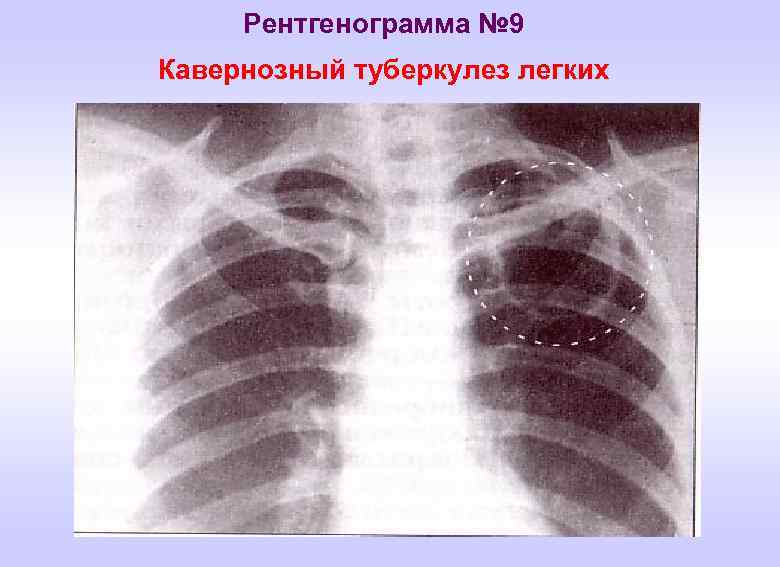 Рентгенограмма № 9 Кавернозный туберкулез легких 