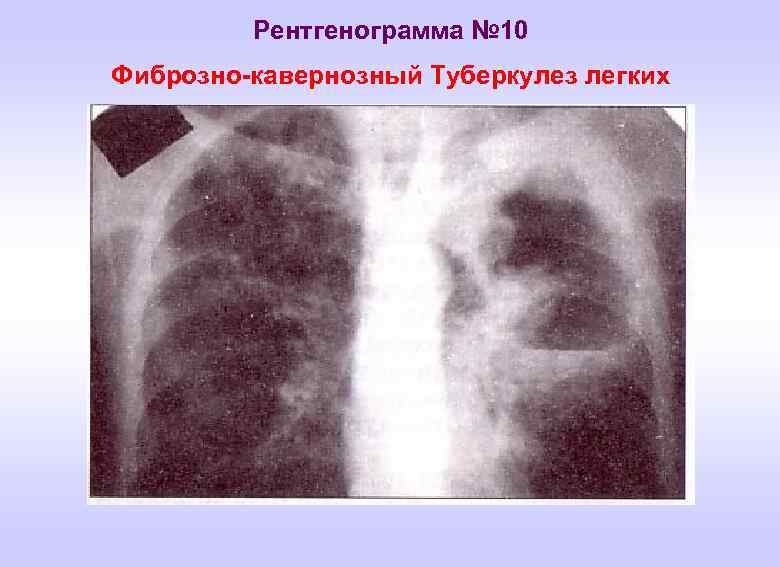 Рентгенограмма № 10 Фиброзно-кавернозный Туберкулез легких 