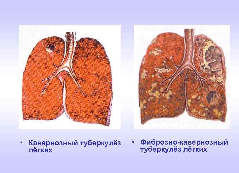 Кавернозный и фиброзно кавернозный туберкулез легких презентация